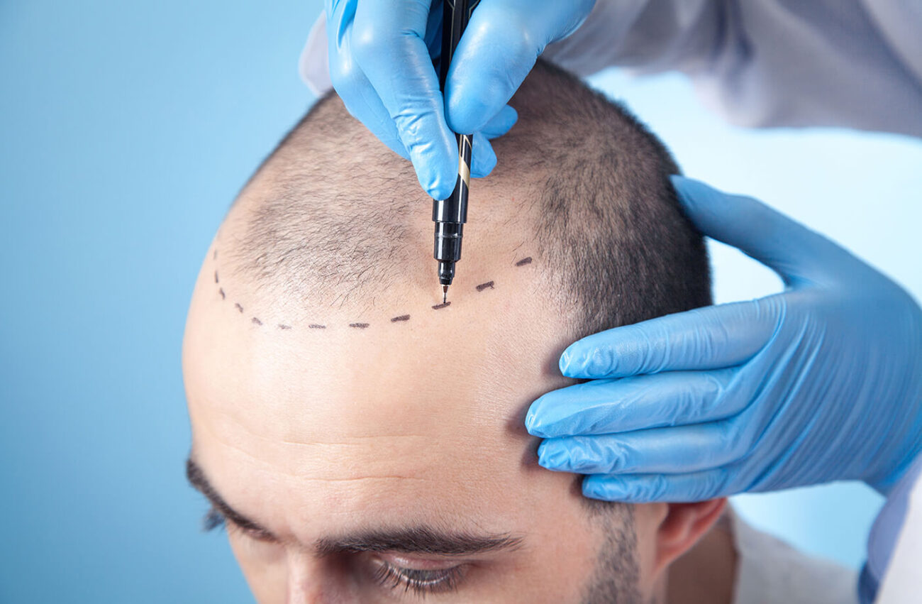 hair transplant